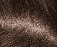 Tóc rụng có hạt trắng ở chân tóc là bị sao?